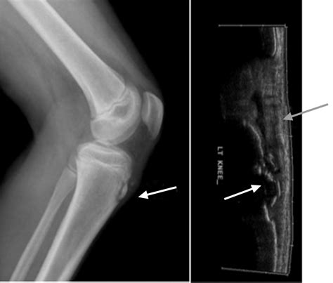 mild tissue injury imaging